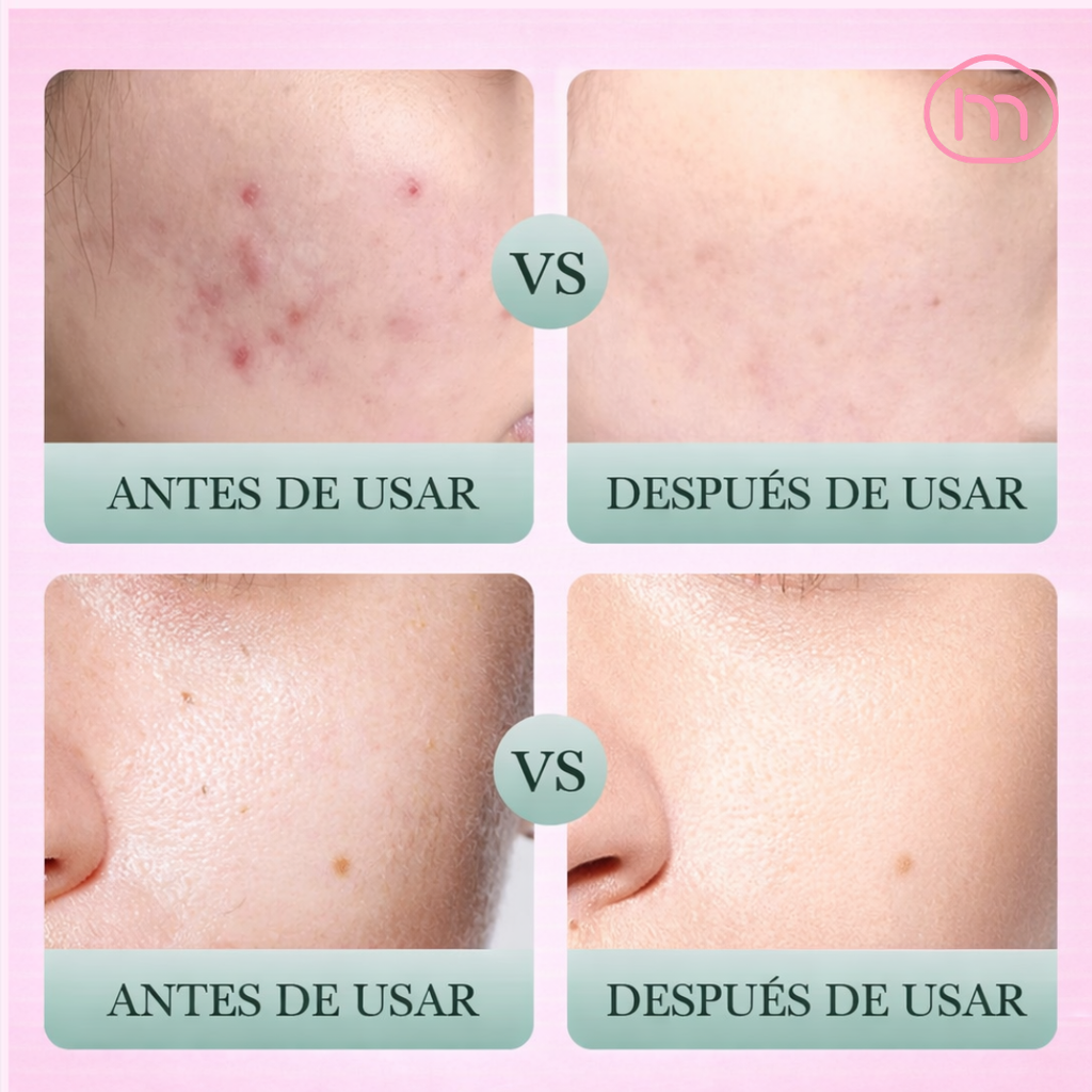 JABON FACIAL ANTIACNE